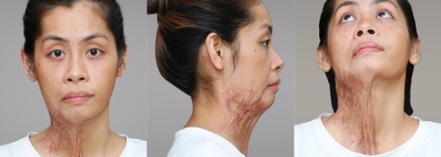 Bệnh viện thẩm mỹ Kangnam tái tạo vết sẹo bỏng axit dài hơn 30 cm